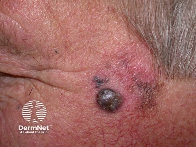 Lentigo maligna melanoma