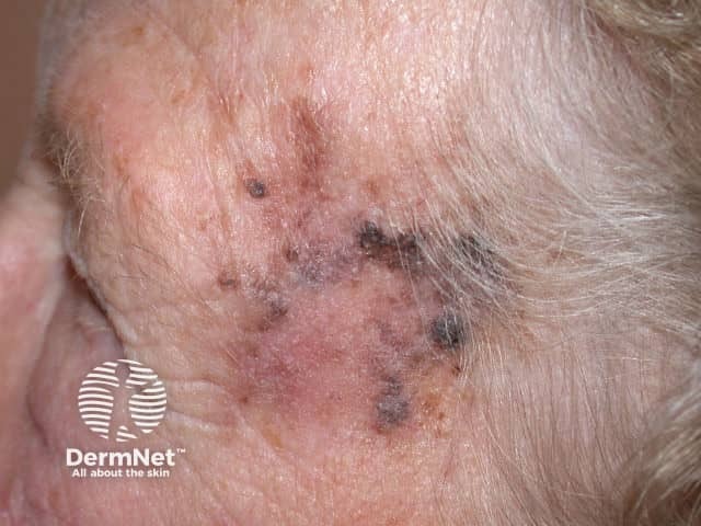 Lentigo maligna melanoma