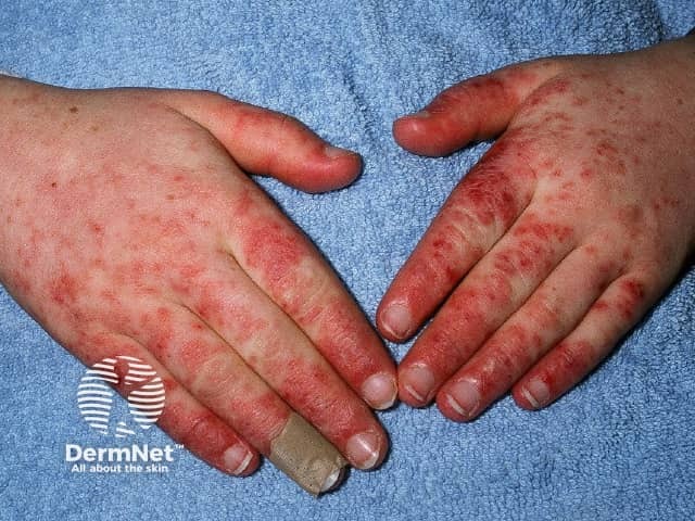 Systemic lupus erythematosus