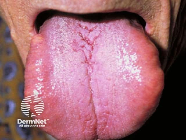 Macroglossia