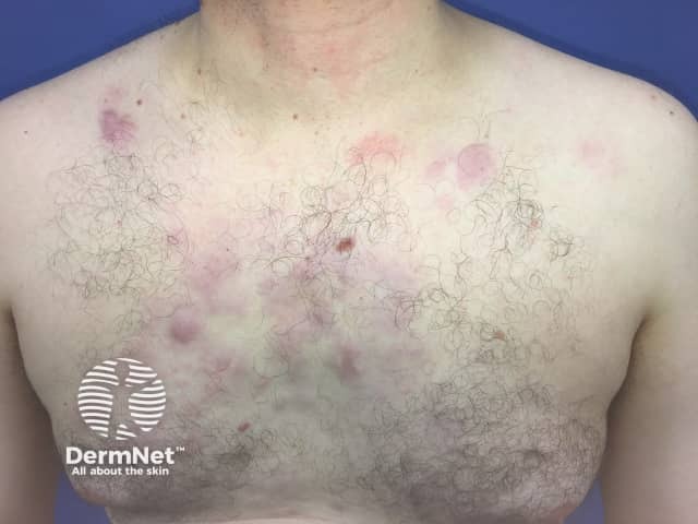 Cutaneous marginal zone lymphoma