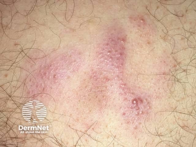 Cutaneous marginal zone lymphoma