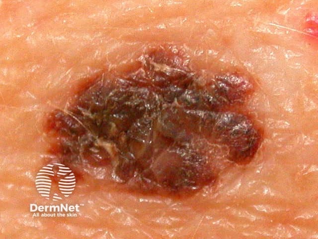 Melanoma in situ