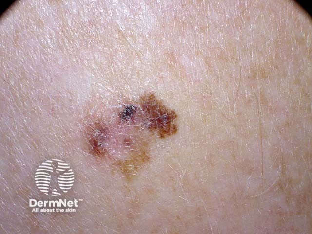 Melanoma