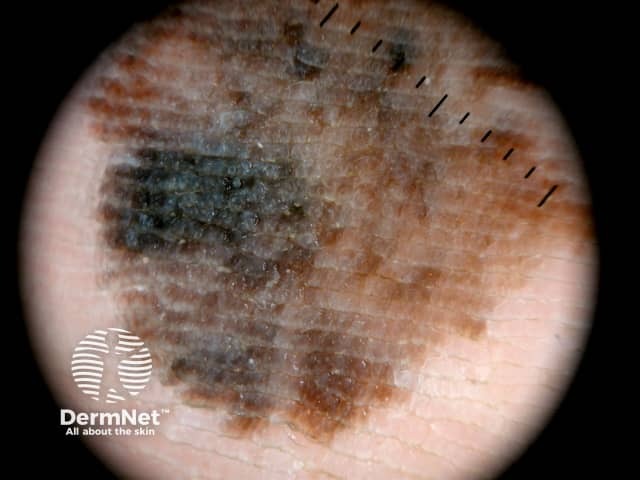 Parallel ridge pattern, asymmetrical structure and diffuse pigmentation