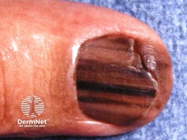 Ungual melanoma