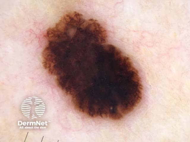 Melanoma