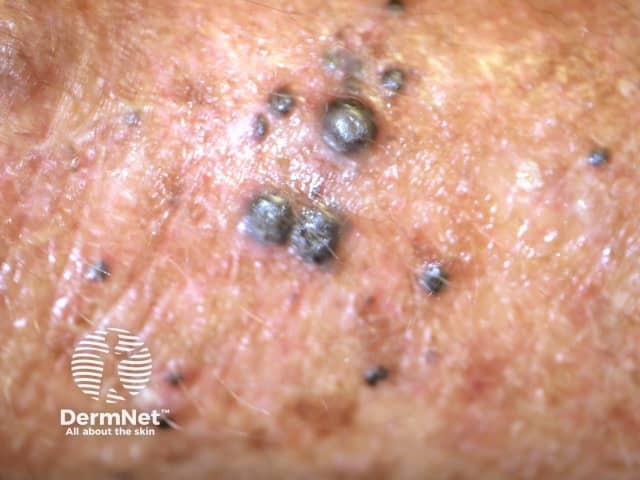 Cutaneous melanoma