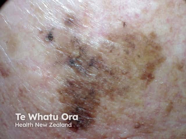 Melanoma with mixed sharp and fading border