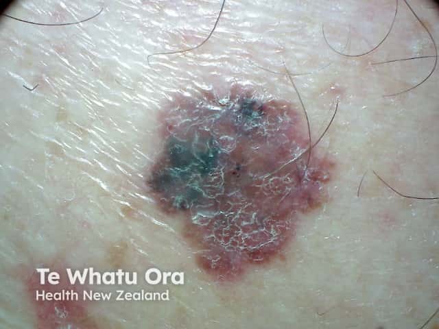 Invasive melanoma