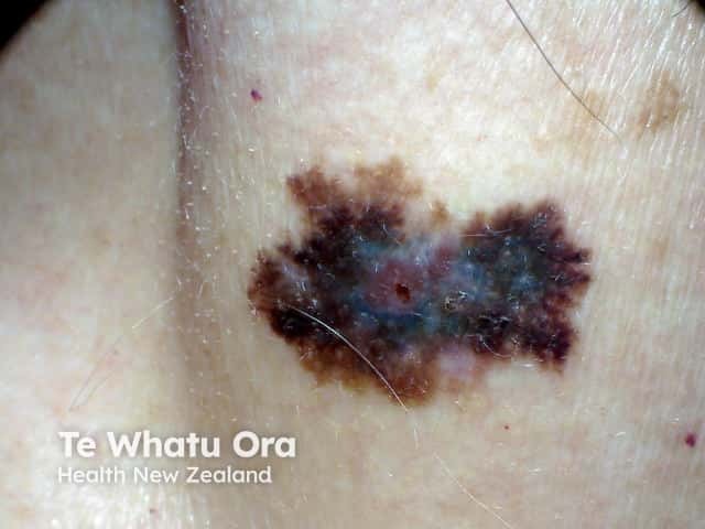 Invasive melanoma