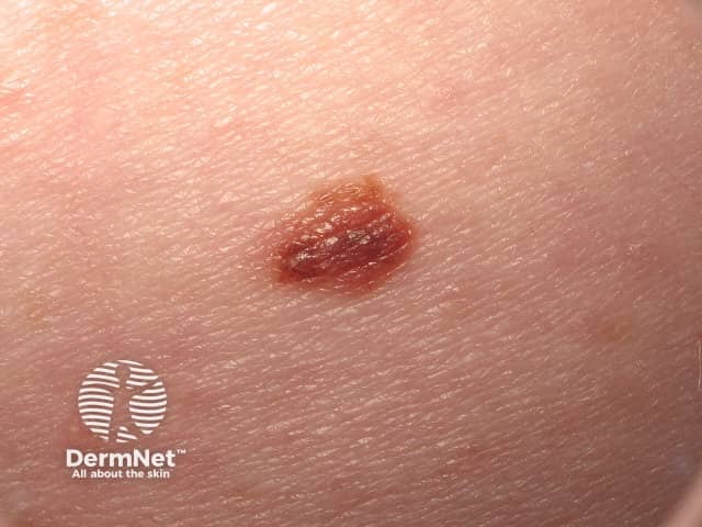 Small melanoma