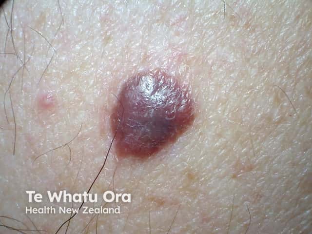 Nodular melanoma