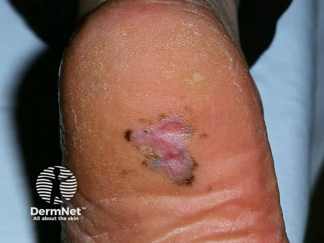 Acral lentiginous melanoma