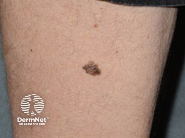 Superficial spreading melanoma