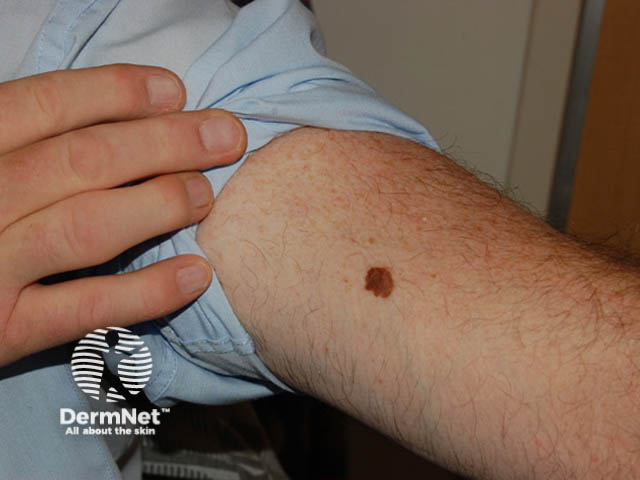 Superficial spreading melanoma