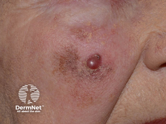 Nodular melanoma