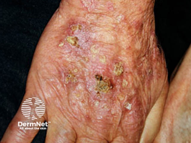 Actinic keratoses