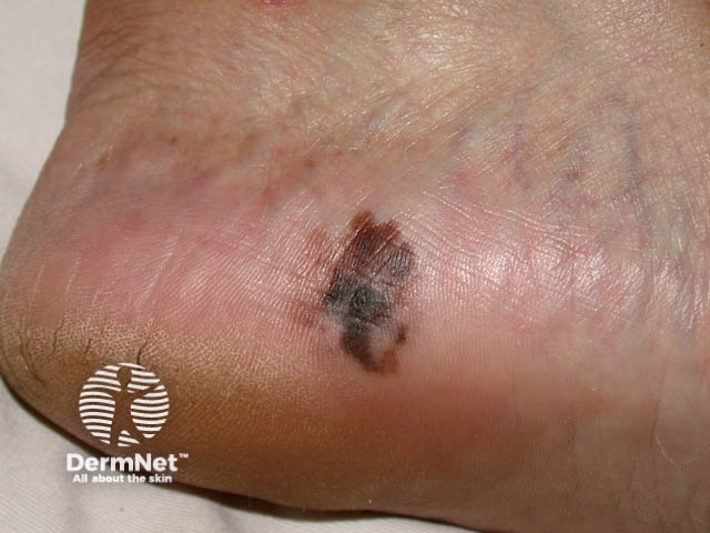 Melanoma in Pacific Islander