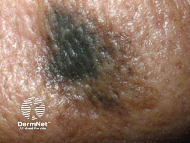 Melanoma in Māori