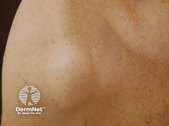 Subcutaneous metastatic melanoma