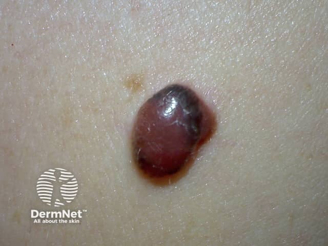 Nodular melanoma