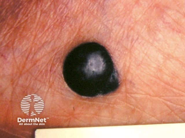 Nodular melanoma