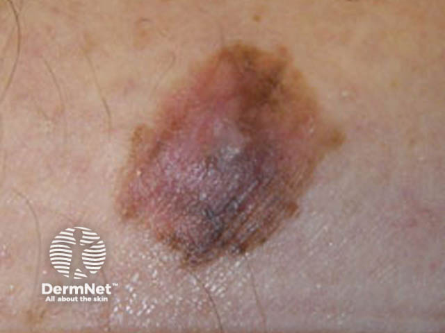 Superficial spreading melanoma