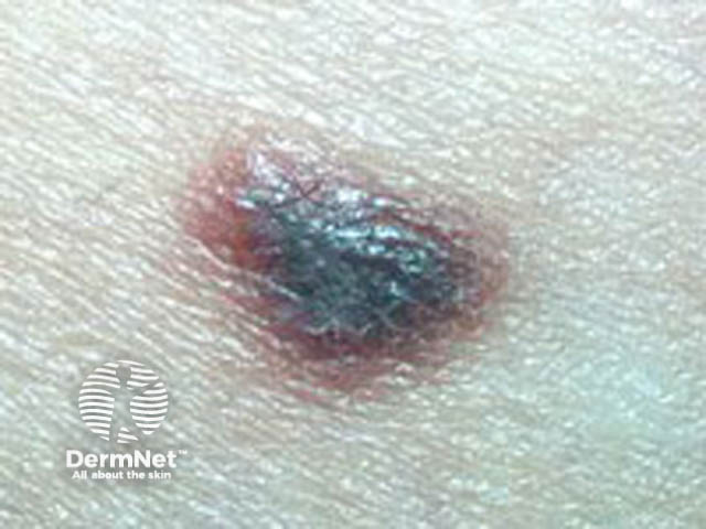 Spitzoid melanoma