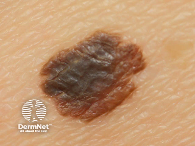 Superficial spreading melanoma