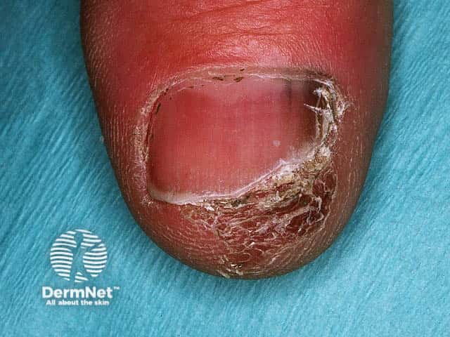 Nail melanoma