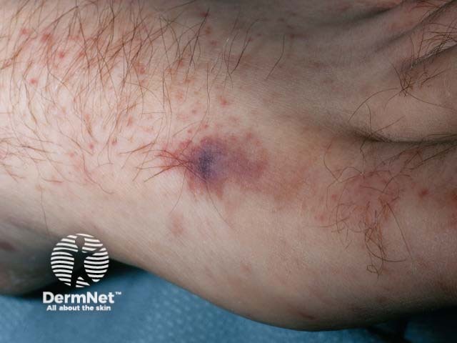 Petechiae due to meningococcal disease