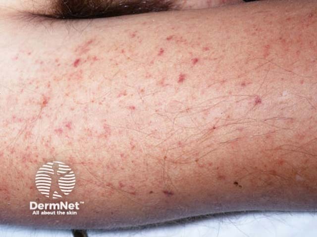 Petechiae due to meningococcal disease