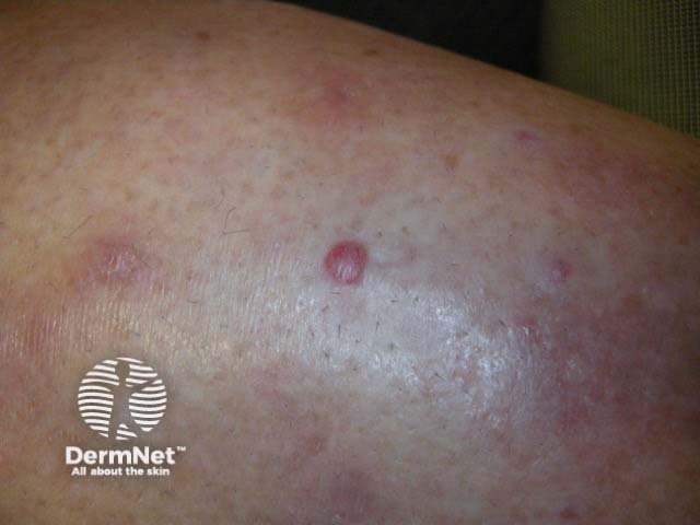 Metastatic melanoma