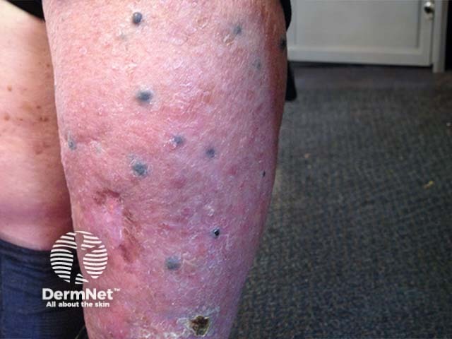 Multiple blue nodules of cutaneous metastatic malignant melanoma