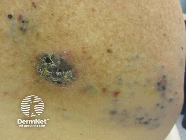 Metastatic melanoma