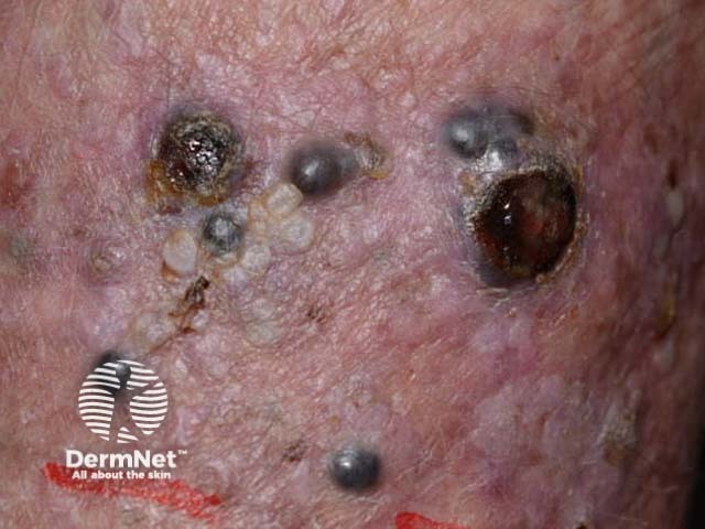 Metastatic melanoma