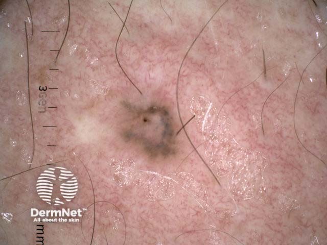 Metastatic melanoma dermoscopy