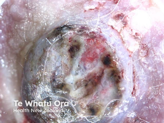 Metastatic melanoma dermoscopy