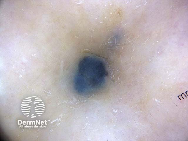 Metastatic melanoma dermoscopy