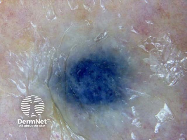 Metastatic melanoma dermoscopy