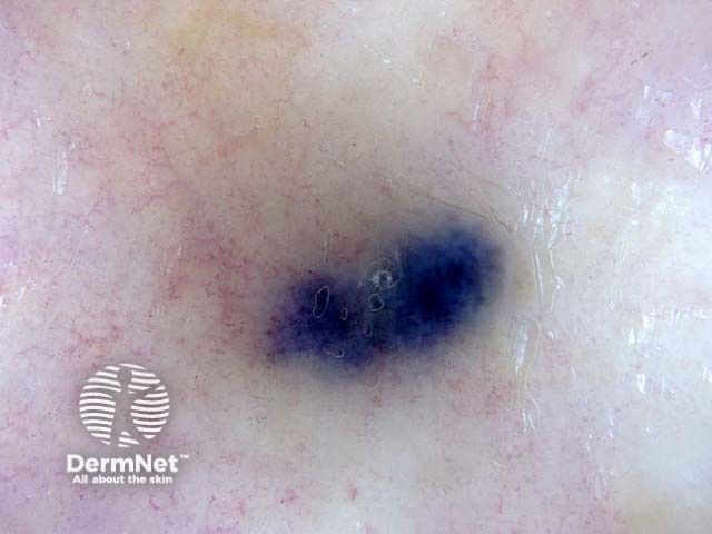 Metastatic melanoma dermoscopy