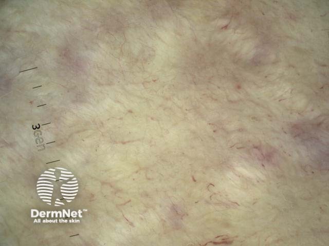 Metastatic melanoma dermoscopy