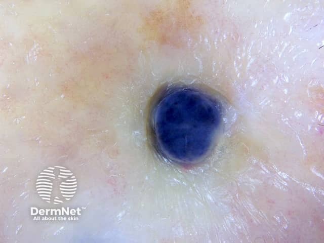 Dermoscopy of metastatic melanoma