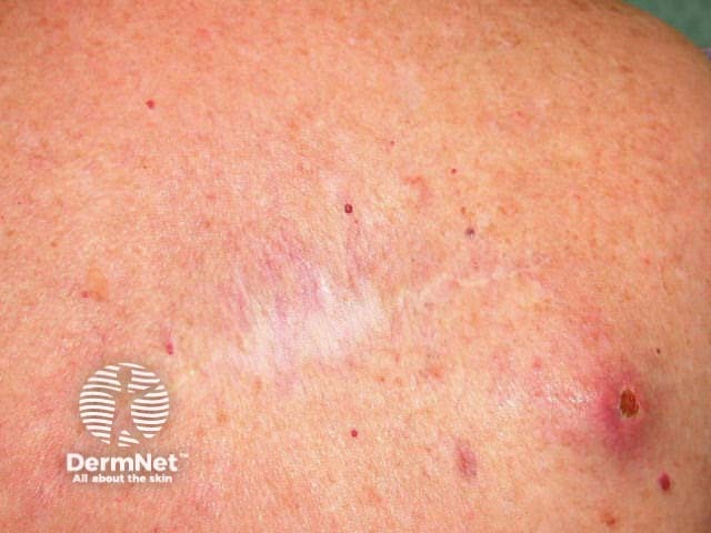 Metastatic melanoma