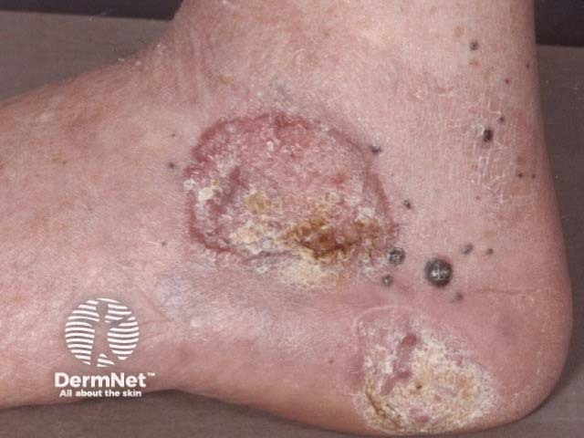 Metastatic melanoma