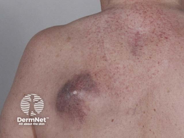 Metastatic melanoma on the chest