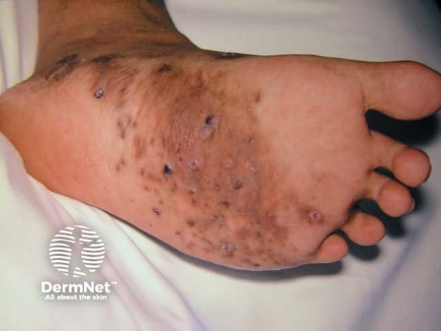 Mycetoma foot