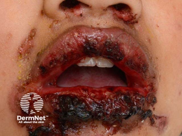 Mucositis due to mycoplasma