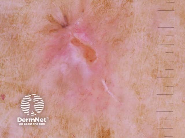 Nodular basal cell carcinoma, polarised dermoscopy view